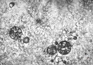 F,25y. | myopathy - atrophic and regenerating muscle cells F,25y. | myopathy - atrophic and regenerating muscle cells